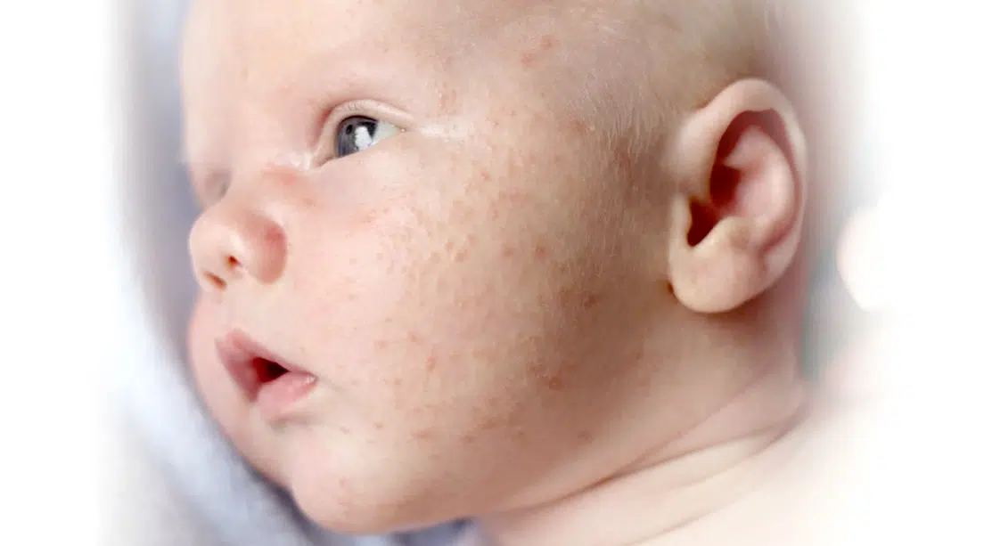 bebé con acné neonatal